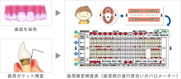 歯周精密検査表（歯周病の進行度合いのバロメーター）