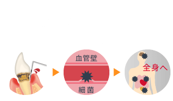 身体に深刻なダメージを与える菌血症（歯原性菌血症）