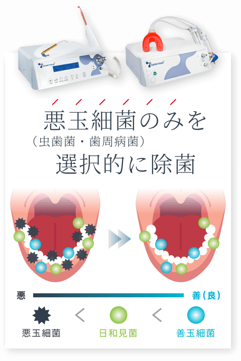 悪玉細菌（虫歯菌・歯周病菌）のみを選択的に除菌