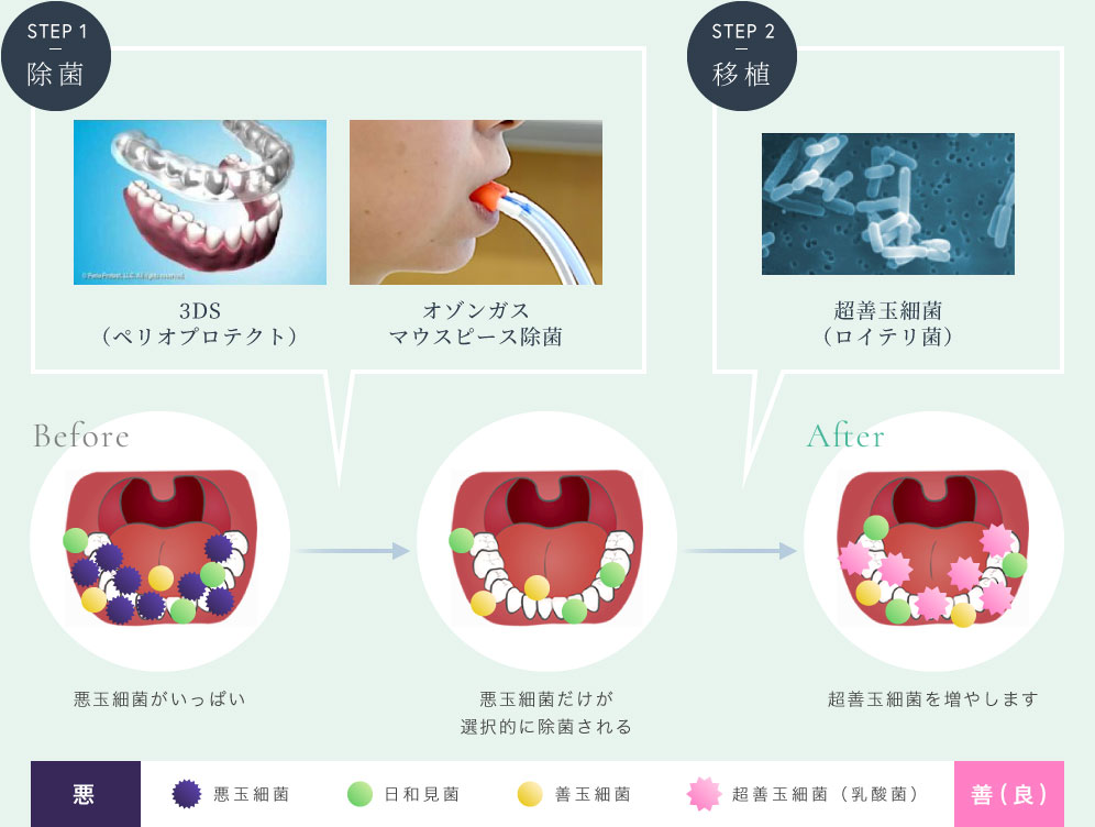 3DSとオゾンガスで歯周病菌を除菌し超善玉細菌（ロイテリ菌）の移植