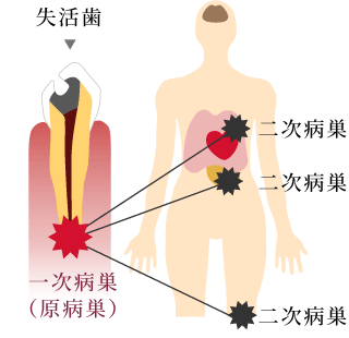 失活歯と全身疾患の関係