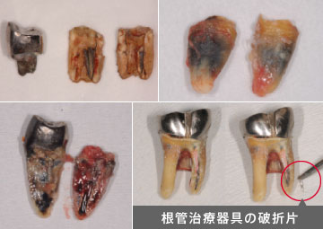 根管治療器具の破折片